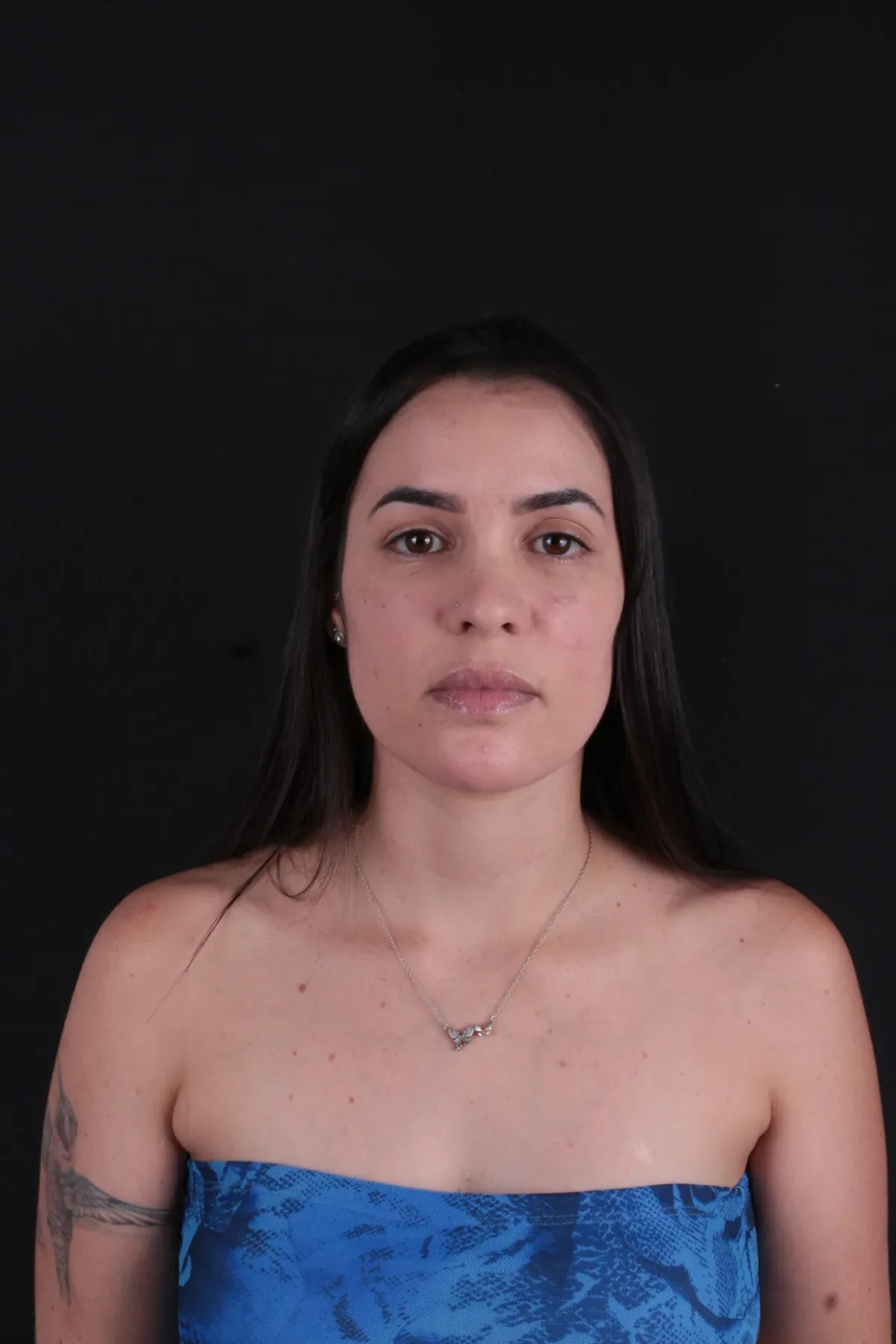 Caso 1, depois do procedimento