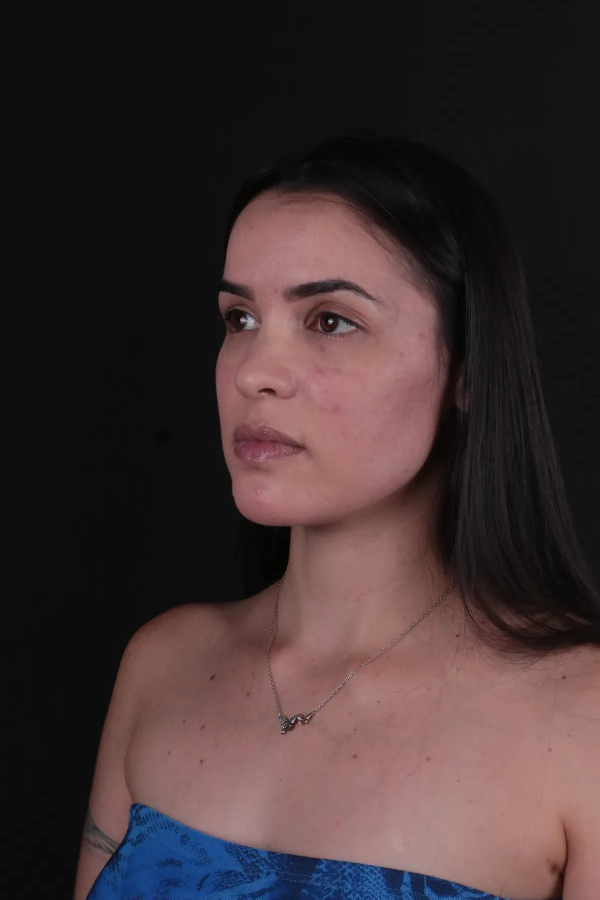 Caso 2, depois do procedimento